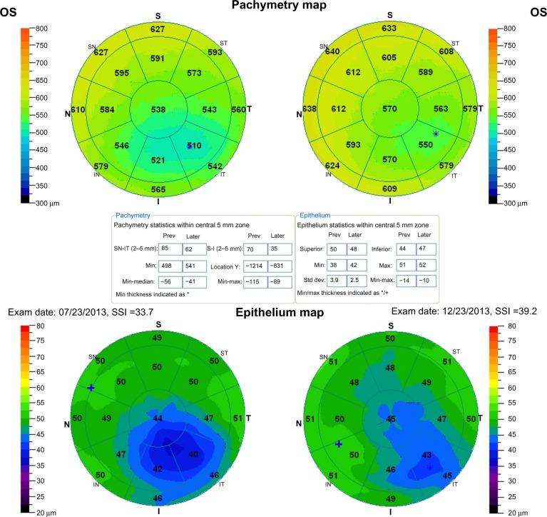 https://cdn.ncbi.nlm.nih.gov/pmc/blobs/ea46/3984063/72936460b2a7/opth-8-697Fig3.jpg