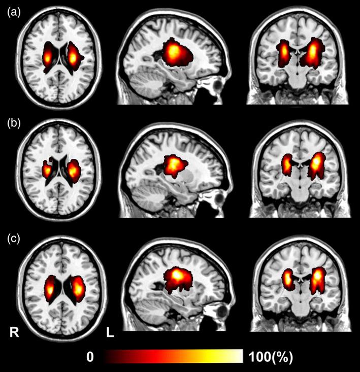 https://cdn.ncbi.nlm.nih.gov/pmc/blobs/ea50/9842916/e47bb316c9e3/HBM-44-727-g004.jpg