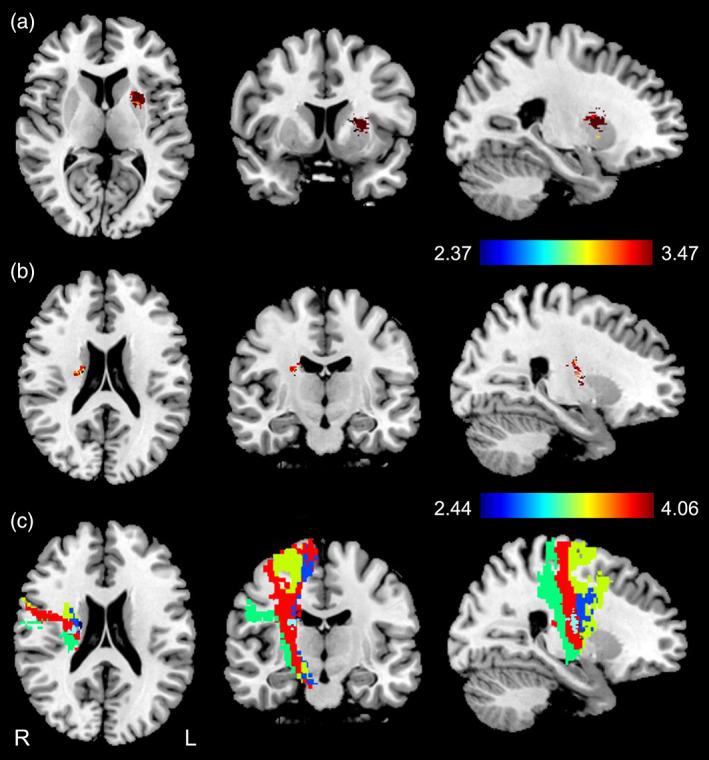 https://cdn.ncbi.nlm.nih.gov/pmc/blobs/ea50/9842916/f956fa086295/HBM-44-727-g003.jpg