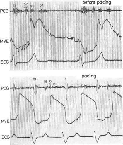 https://cdn.ncbi.nlm.nih.gov/pmc/blobs/eacc/482247/dbc31066dd11/brheartj00191-0100-a.jpg