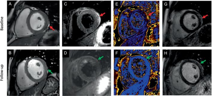 https://cdn.ncbi.nlm.nih.gov/pmc/blobs/eb17/9538893/6e2e28bedc73/EJHF-9999-0-g007.jpg
