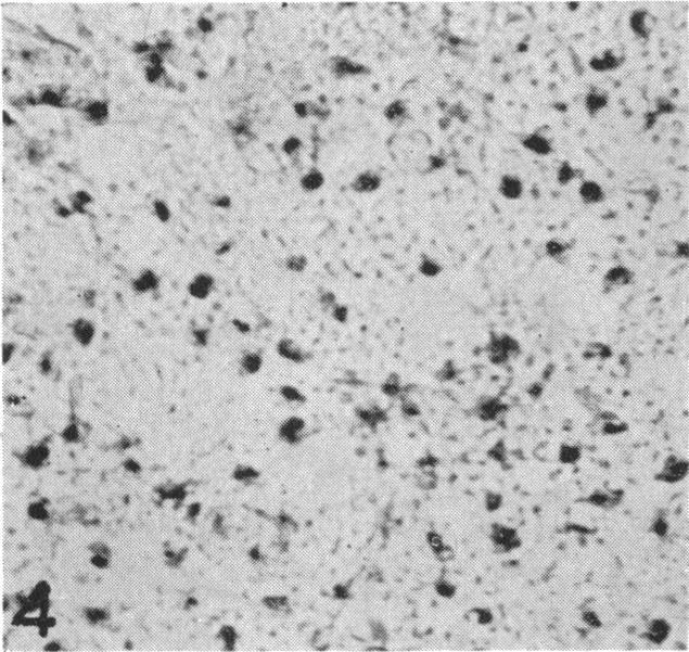 https://cdn.ncbi.nlm.nih.gov/pmc/blobs/eb2f/2035359/4cddece25856/brmedj03175-0019-d.jpg