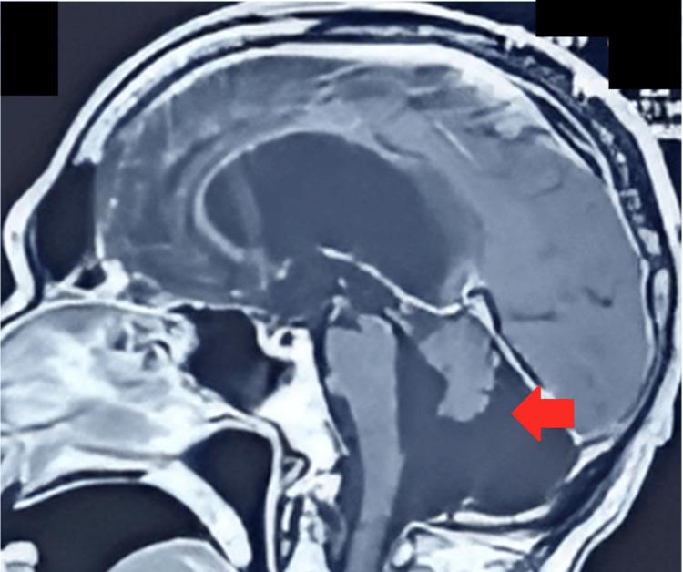 https://cdn.ncbi.nlm.nih.gov/pmc/blobs/eb49/12178834/876e4ae31396/cureus-0017-00000084423-i01.jpg