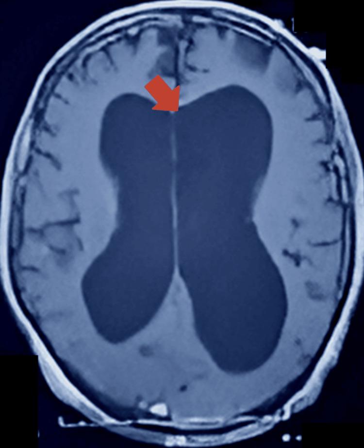 https://cdn.ncbi.nlm.nih.gov/pmc/blobs/eb49/12178834/9167ce43e1e7/cureus-0017-00000084423-i03.jpg