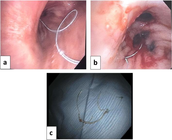 https://cdn.ncbi.nlm.nih.gov/pmc/blobs/eb5d/12040520/db31aefebea2/RCR2-13-e70198-g004.jpg
