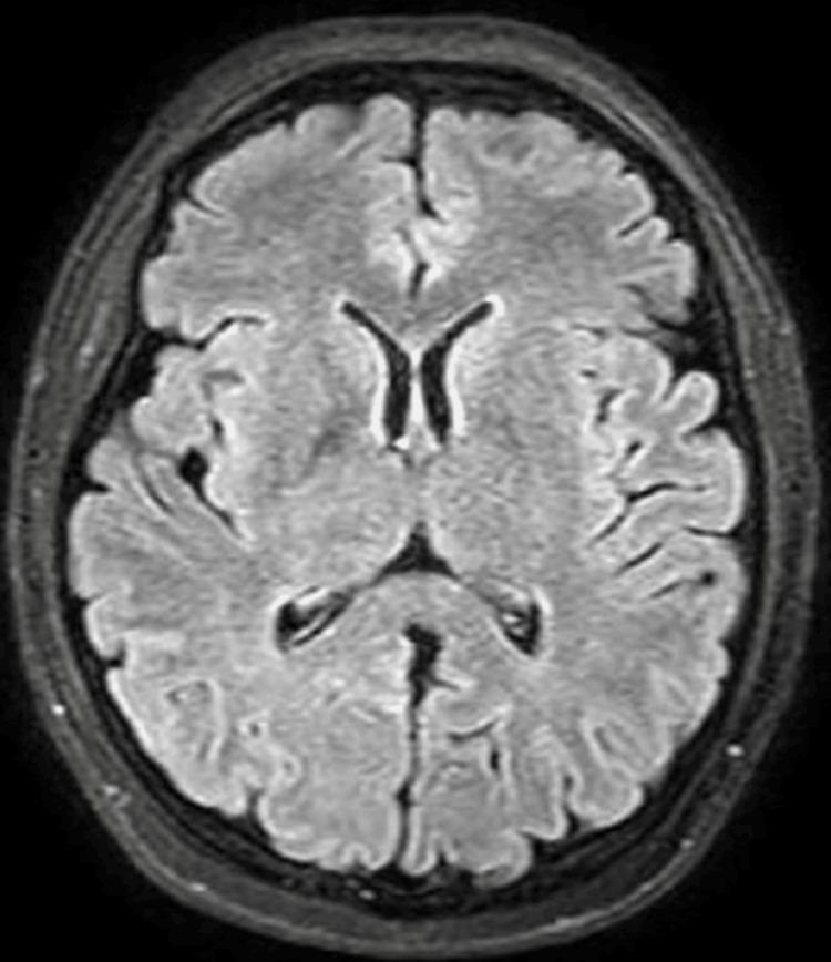 https://cdn.ncbi.nlm.nih.gov/pmc/blobs/eb99/11410296/6706172b63ae/cureus-0016-00000067222-i01.jpg