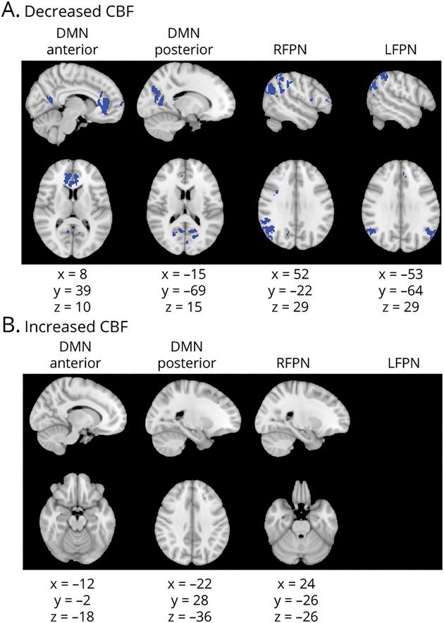 https://cdn.ncbi.nlm.nih.gov/pmc/blobs/ebc8/8601205/97dc99dc0514/NEUROLOGY2021171238F4.jpg