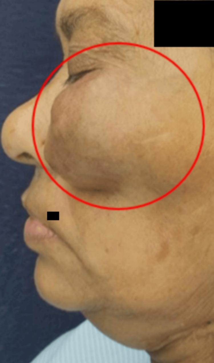 https://cdn.ncbi.nlm.nih.gov/pmc/blobs/ebfe/11151140/98a50cd30d78/cureus-0016-00000059701-i02.jpg