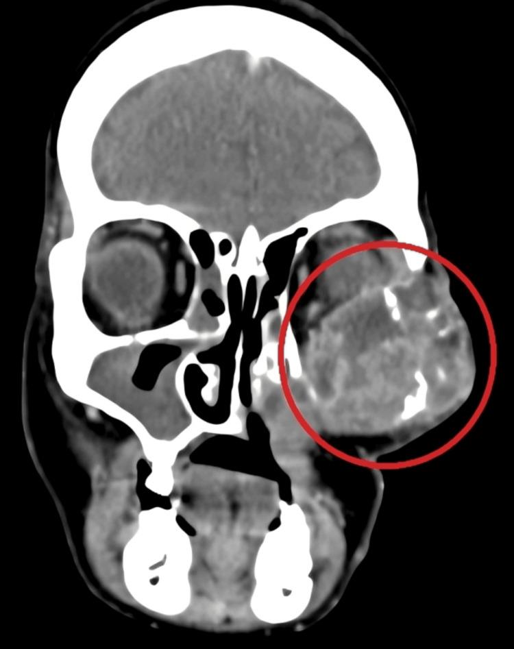 https://cdn.ncbi.nlm.nih.gov/pmc/blobs/ebfe/11151140/d5cda25474d0/cureus-0016-00000059701-i05.jpg