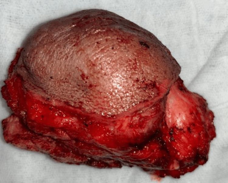 https://cdn.ncbi.nlm.nih.gov/pmc/blobs/ebfe/11151140/f646460db347/cureus-0016-00000059701-i09.jpg