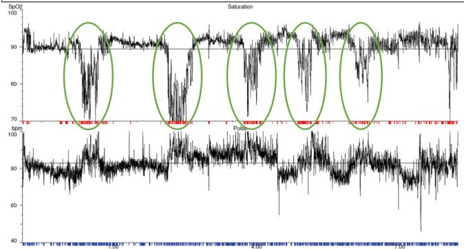 https://cdn.ncbi.nlm.nih.gov/pmc/blobs/ec4b/7642631/2a003d1943c6/jtd-12-S2-S202-f4.jpg