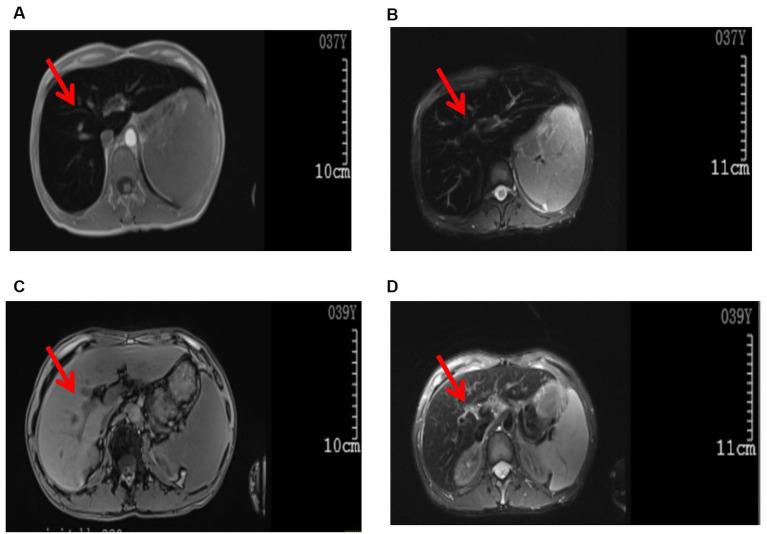 https://cdn.ncbi.nlm.nih.gov/pmc/blobs/ec91/11239416/b9ccd9167476/fmed-11-1417611-g001.jpg
