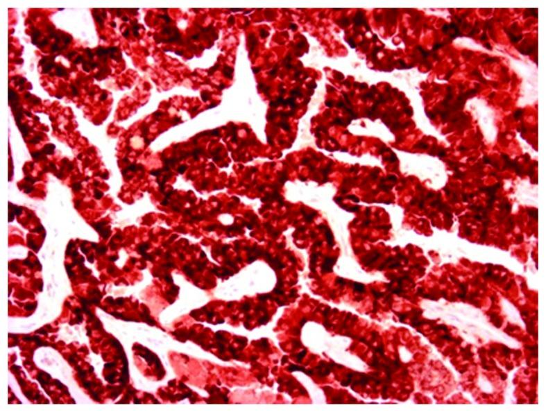 https://cdn.ncbi.nlm.nih.gov/pmc/blobs/ec99/5649005/27098c73a557/mco-07-05-0777-g06.jpg