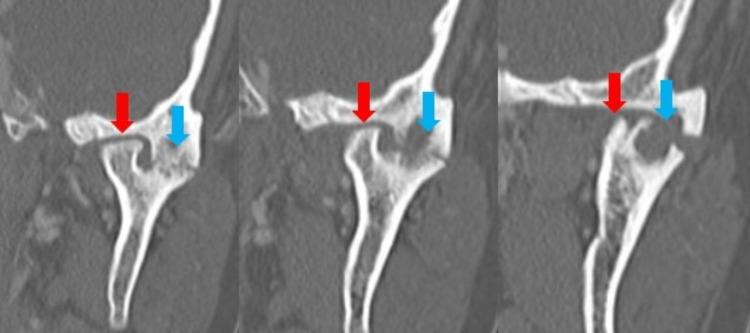 https://cdn.ncbi.nlm.nih.gov/pmc/blobs/ecc8/9605739/f6712d7b60d9/cureus-0014-00000029624-i01.jpg