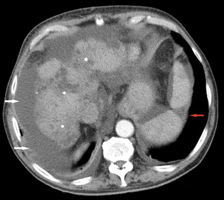 https://cdn.ncbi.nlm.nih.gov/pmc/blobs/eccb/11067400/3582a9cb32f3/cureus-0016-00000057509-i02.jpg