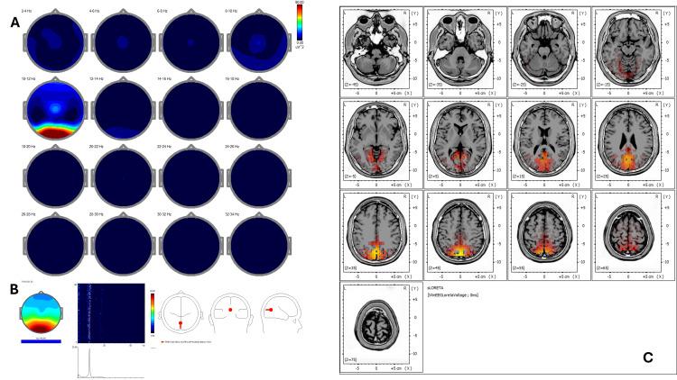 https://cdn.ncbi.nlm.nih.gov/pmc/blobs/ed06/12377494/1334a8e04fca/cureus-0017-00000090951-i06.jpg