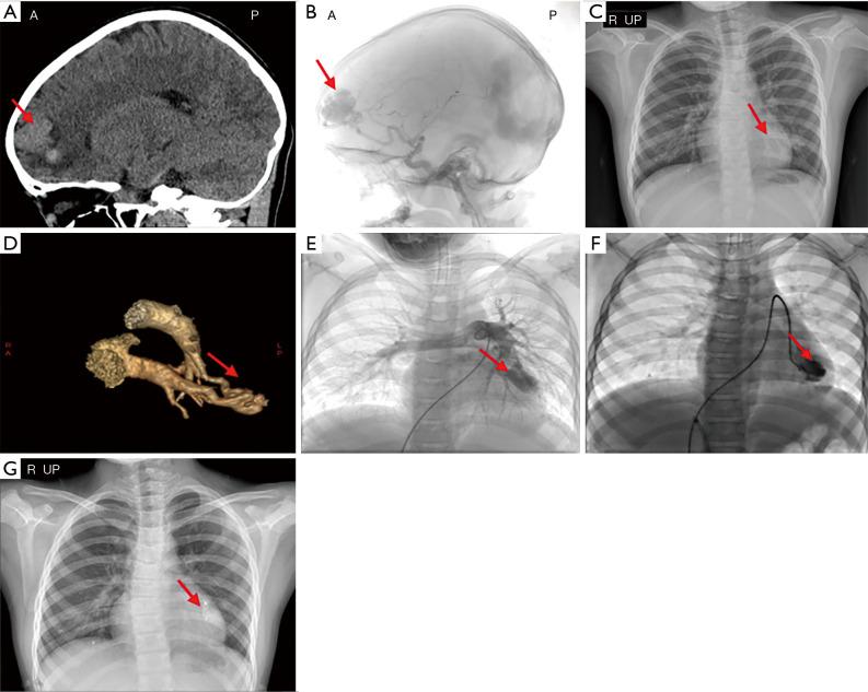 https://cdn.ncbi.nlm.nih.gov/pmc/blobs/ed1e/8429878/cbcc193d7e93/tp-10-08-2123-f1.jpg