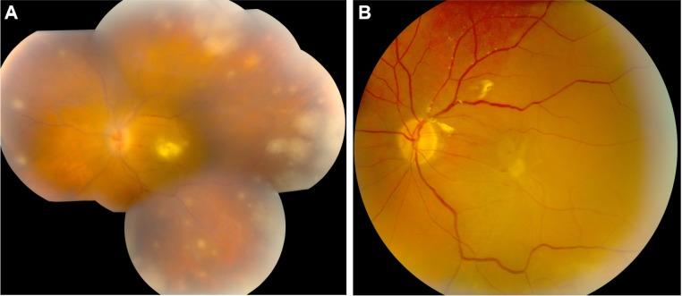 https://cdn.ncbi.nlm.nih.gov/pmc/blobs/ed96/4514312/0134371e586f/opth-9-1307Fig2.jpg