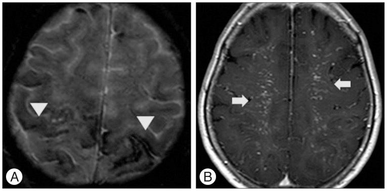 https://cdn.ncbi.nlm.nih.gov/pmc/blobs/eda6/4323506/a0f1dda846c1/jkns-57-54-g001.jpg