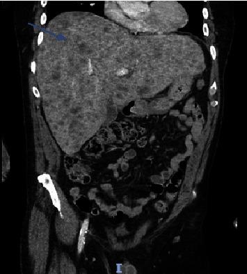 https://cdn.ncbi.nlm.nih.gov/pmc/blobs/edc9/11132830/ef4d486342d2/CRIONM2024-8792291.003.jpg