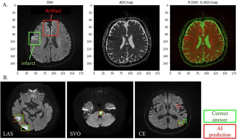 https://cdn.ncbi.nlm.nih.gov/pmc/blobs/edfa/10753815/64b58b6e4076/fneur-14-1295642-g002.jpg