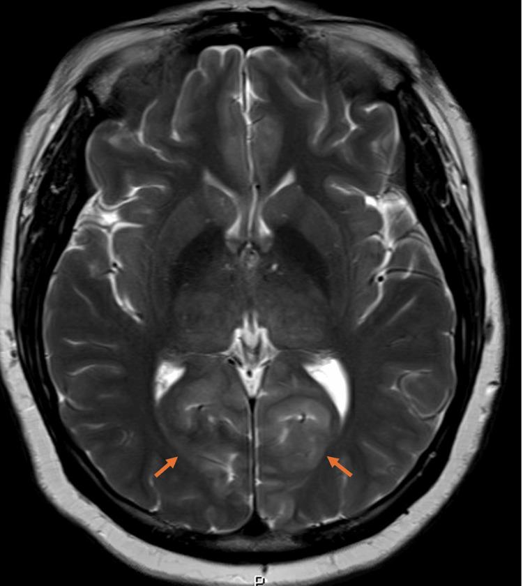https://cdn.ncbi.nlm.nih.gov/pmc/blobs/ef0e/12352461/494838c3b8e7/cureus-0017-00000087995-i03.jpg