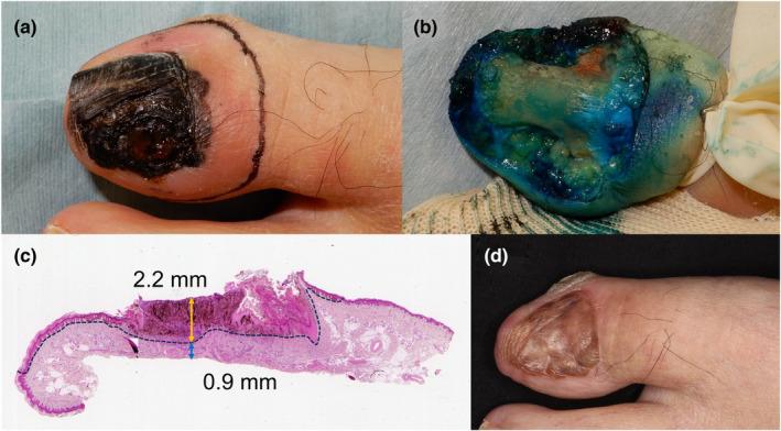 https://cdn.ncbi.nlm.nih.gov/pmc/blobs/ef50/11484139/d0c534d1f0ea/JDE-51--g001.jpg