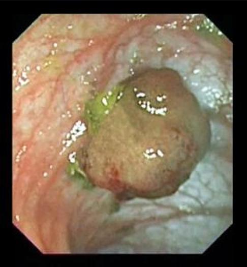 https://cdn.ncbi.nlm.nih.gov/pmc/blobs/ef78/3081504/4db21855f228/LJM-1-096-g005.jpg