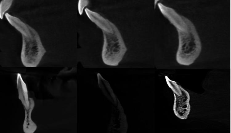 https://cdn.ncbi.nlm.nih.gov/pmc/blobs/efa4/11628873/b7ddf303b5c1/cureus-0016-00000073355-i06.jpg