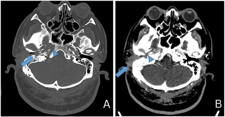 https://cdn.ncbi.nlm.nih.gov/pmc/blobs/efae/10853034/6171cb865432/cureus-0016-00000051973-i02.jpg