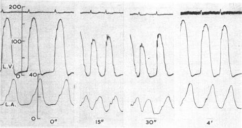 https://cdn.ncbi.nlm.nih.gov/pmc/blobs/efc8/1018114/adcbf962ee08/brheartj00343-0097-b.jpg