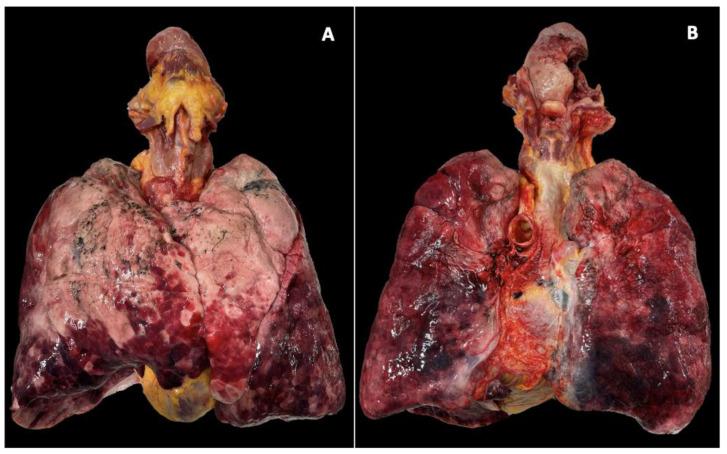 https://cdn.ncbi.nlm.nih.gov/pmc/blobs/efca/11396599/aae82457cb3d/jcm-13-05198-g001.jpg