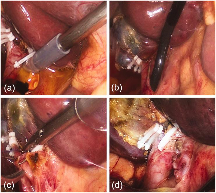 https://cdn.ncbi.nlm.nih.gov/pmc/blobs/f024/7262853/4638a9e1c89a/10.1177_0300060519878087-fig1.jpg