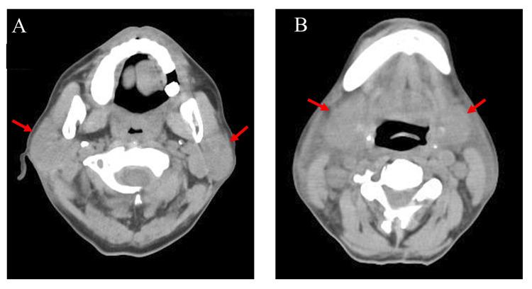 https://cdn.ncbi.nlm.nih.gov/pmc/blobs/f08a/10257532/dc5d54e32b9b/cureus-0015-00000038905-i02.jpg