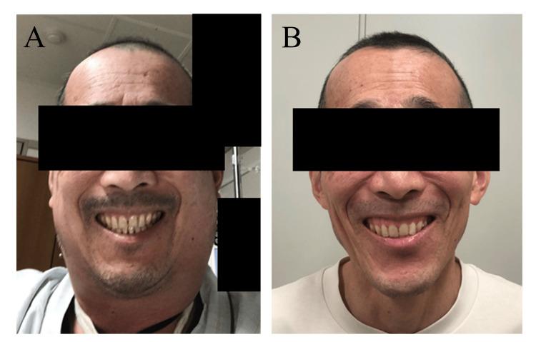 https://cdn.ncbi.nlm.nih.gov/pmc/blobs/f08a/10257532/ef7ac621ed40/cureus-0015-00000038905-i01.jpg