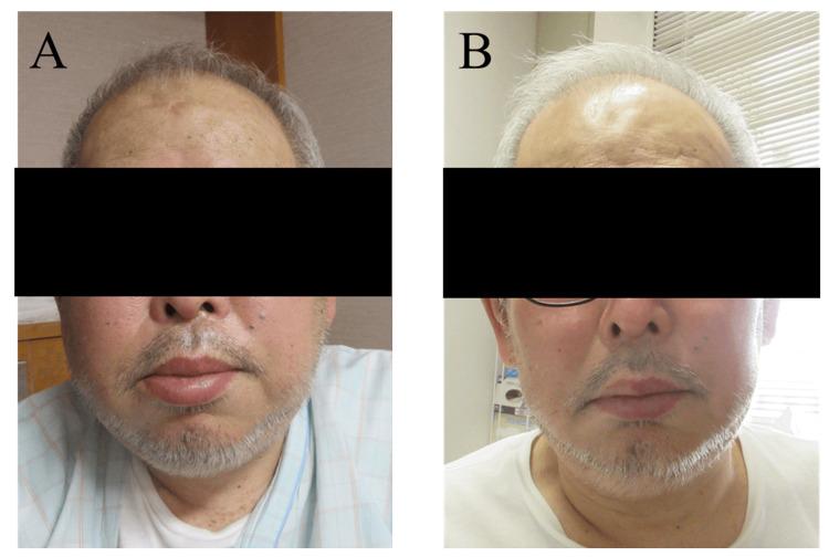 https://cdn.ncbi.nlm.nih.gov/pmc/blobs/f08a/10257532/f1526f01f1a1/cureus-0015-00000038905-i03.jpg