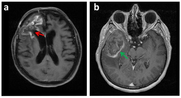 https://cdn.ncbi.nlm.nih.gov/pmc/blobs/f0bc/8750680/c5bc5826f7c9/cancers-14-00074-g003.jpg