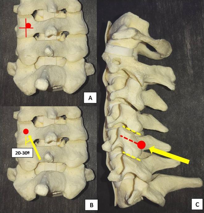 https://cdn.ncbi.nlm.nih.gov/pmc/blobs/f0bd/6232718/c1a30e223ffe/10.1177_2192568218759940-fig3.jpg