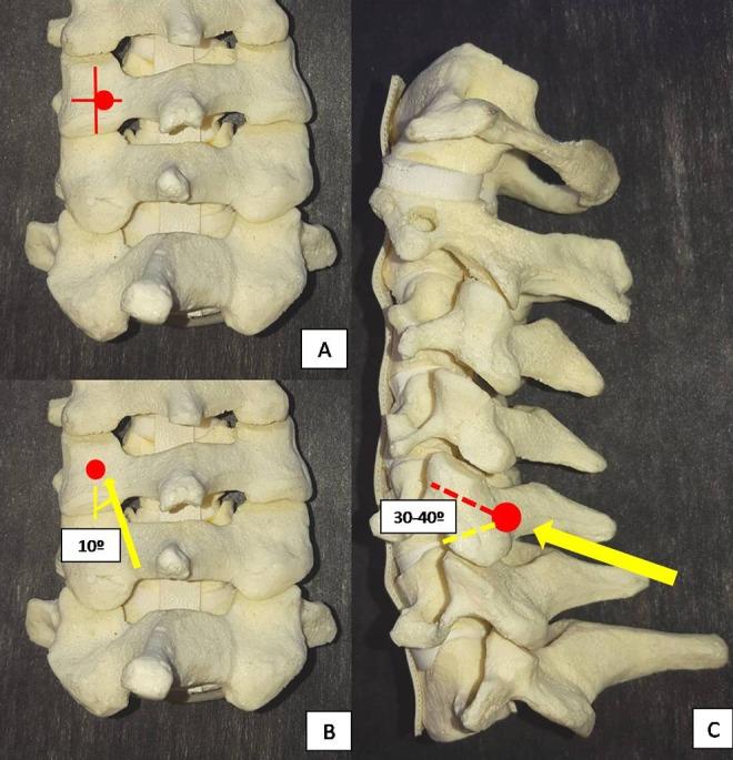 https://cdn.ncbi.nlm.nih.gov/pmc/blobs/f0bd/6232718/cdcc3bafb346/10.1177_2192568218759940-fig4.jpg