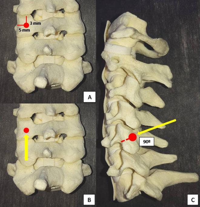https://cdn.ncbi.nlm.nih.gov/pmc/blobs/f0bd/6232718/d42d45f1da44/10.1177_2192568218759940-fig2.jpg