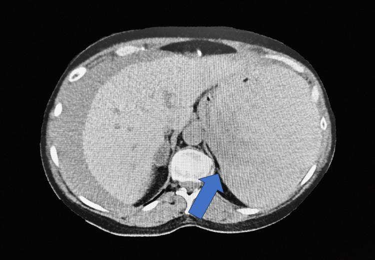 https://cdn.ncbi.nlm.nih.gov/pmc/blobs/f126/10505043/0add6bee9edf/cureus-0015-00000045364-i02.jpg