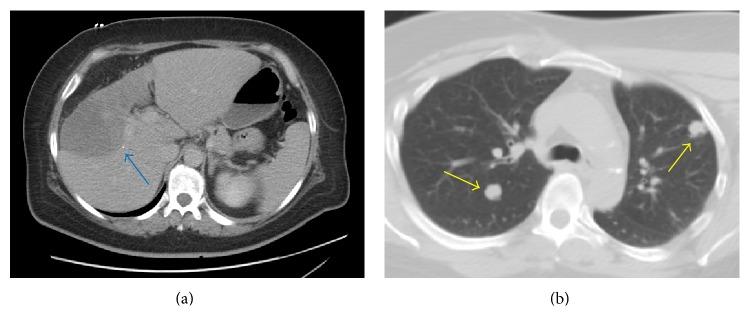 https://cdn.ncbi.nlm.nih.gov/pmc/blobs/f17b/4488146/4ee2d95f054c/CRIGM2015-326795.001.jpg