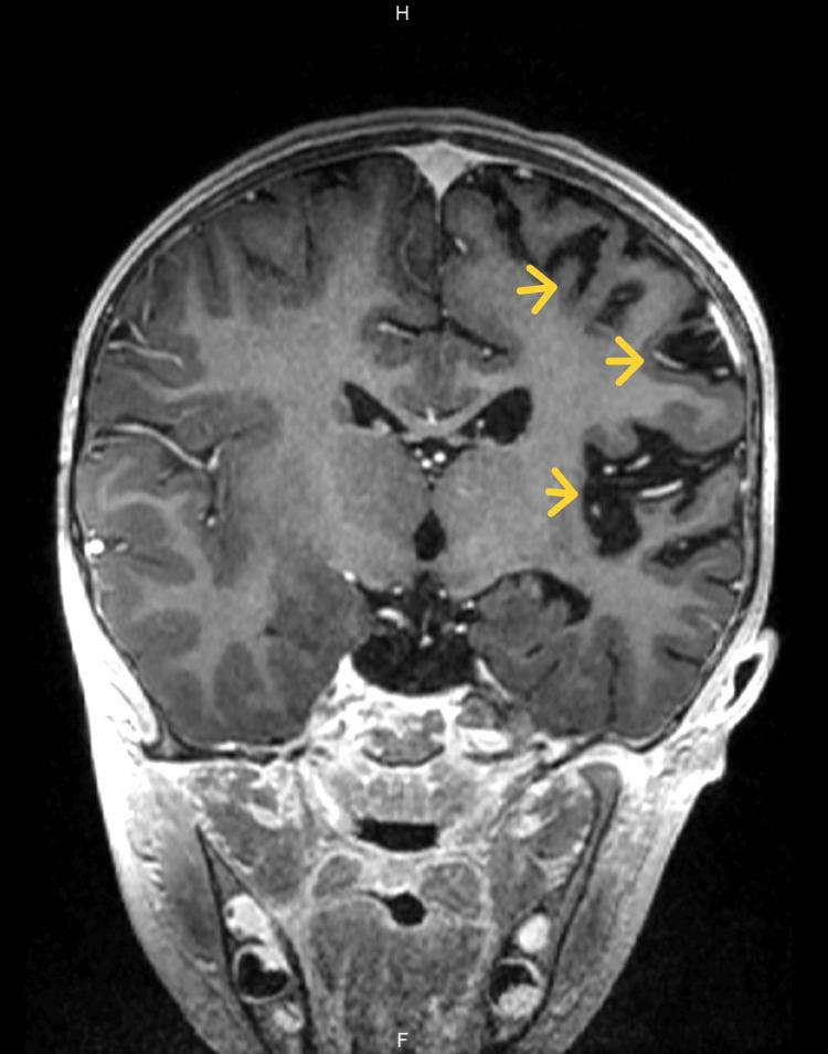 https://cdn.ncbi.nlm.nih.gov/pmc/blobs/f18b/10560088/c816bbd6cc70/cureus-0015-00000046647-i05.jpg