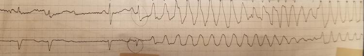https://cdn.ncbi.nlm.nih.gov/pmc/blobs/f193/10181950/843d82a6533a/cureus-0015-00000037507-i02.jpg