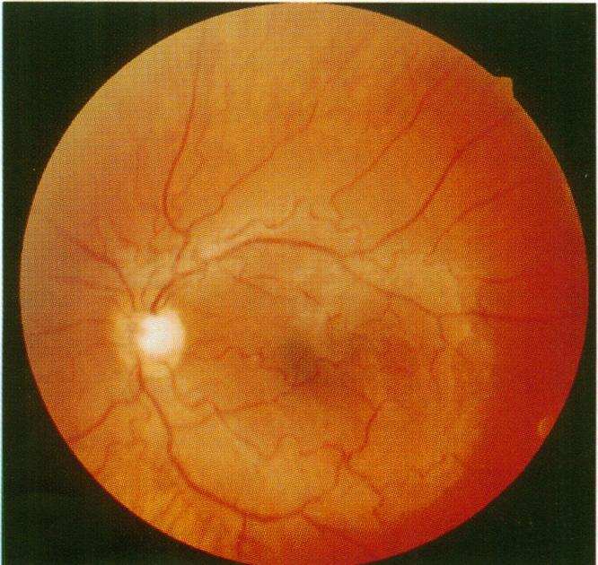 https://cdn.ncbi.nlm.nih.gov/pmc/blobs/f199/505538/a6ee8ac12ddf/brjopthal00006-0087-c.jpg