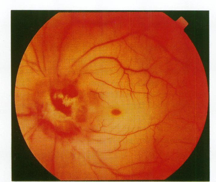 https://cdn.ncbi.nlm.nih.gov/pmc/blobs/f199/505538/f7c15e658b5e/brjopthal00006-0086-a.jpg