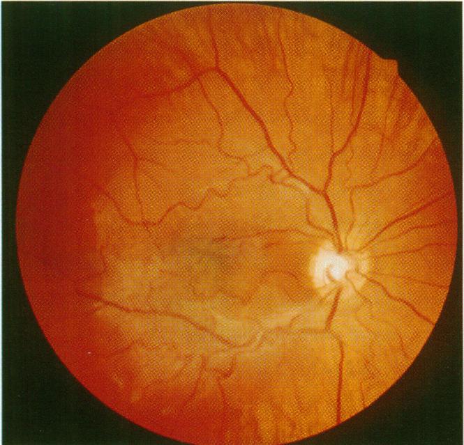 https://cdn.ncbi.nlm.nih.gov/pmc/blobs/f199/505538/ffccda0175d5/brjopthal00006-0087-b.jpg