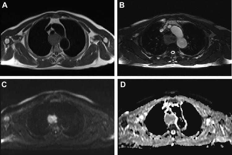 https://cdn.ncbi.nlm.nih.gov/pmc/blobs/f200/6886268/e93a55fe08a7/10.1177_1533033819892254-fig1.jpg