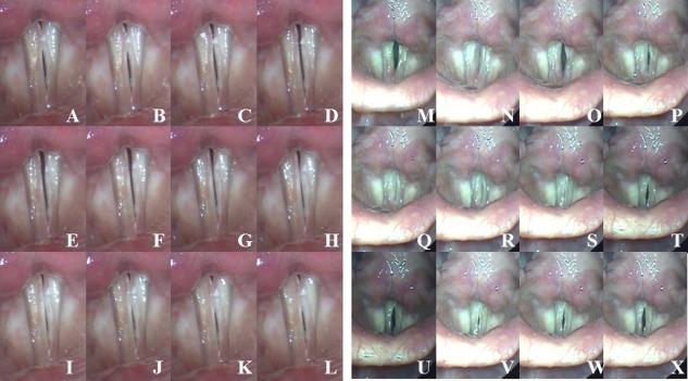 https://cdn.ncbi.nlm.nih.gov/pmc/blobs/f24d/6718003/060b89d9a1ea/LARY-125-E338-g002.jpg