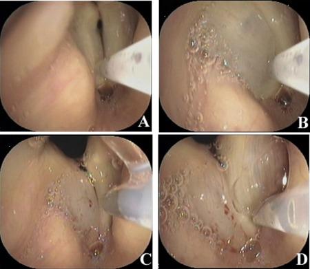 https://cdn.ncbi.nlm.nih.gov/pmc/blobs/f24d/6718003/c052995f0b45/LARY-125-E338-g001.jpg